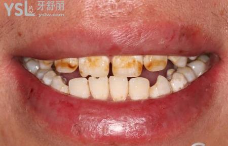 氟斑牙的特點是什么？