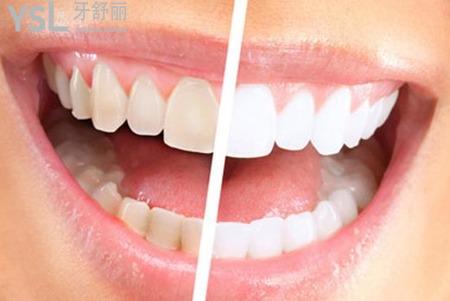 牙齒發(fā)黃怎么辦？