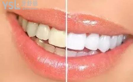 為什么每天刷牙牙齒還是很黃？