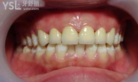 氟斑牙有什么注意事項(xiàng)？
