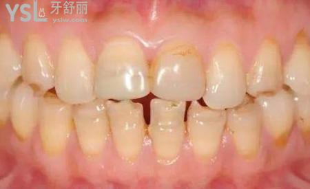 牙齒很黃怎么辦？