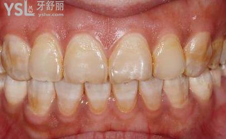 氟斑牙用小蘇打好嗎？