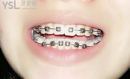 拔牙矯正有后遺癥嗎？