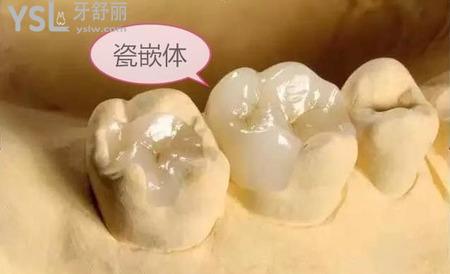 嵌體補(bǔ)牙后能用幾年？