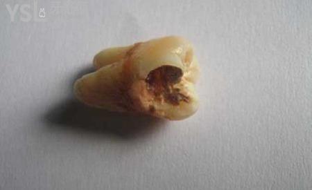 智齒爛了大洞疼得要死怎么辦？