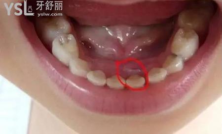 智齒不疼拔不拔？