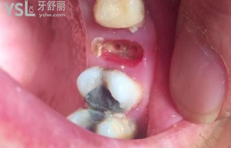 拔智齒后牙洞塞食物怎么辦？