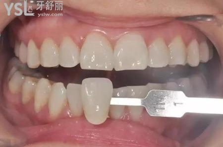 貼完牙貼牙齒酸睡不著怎么辦？
