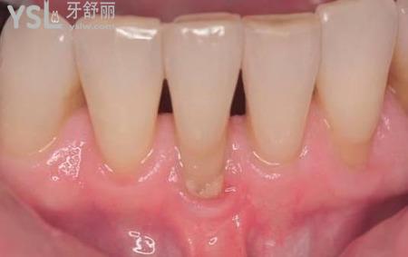 牙根長在外面了怎么辦？