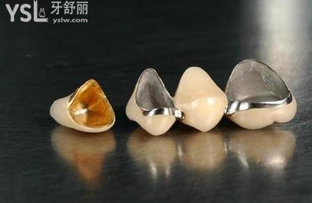 金屬牙和陶瓷牙哪個(gè)好？