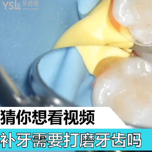 補(bǔ)牙需要打磨牙齒嗎？