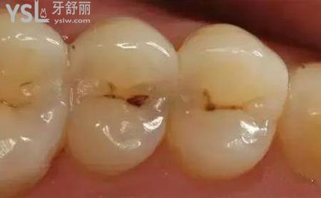 牙齒上有黑點是什么情況？