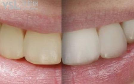 全瓷牙的優(yōu)點有哪些？