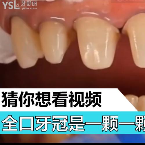 全口牙冠是一顆一顆的做的嗎？