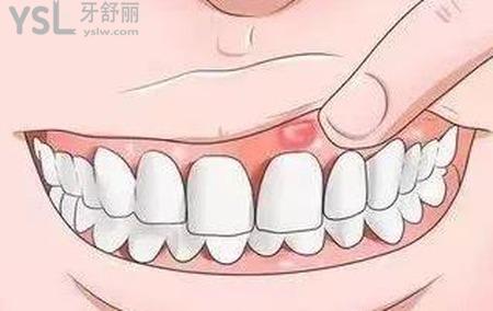 牙齦上面長了個泡怎么辦？