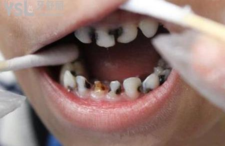 后槽牙里面凹陷處發(fā)黑怎么辦？
