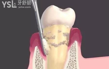晚期牙周炎的表現(xiàn)是什么樣的？