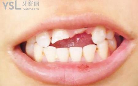 牙斷掉了牙根還需要拔掉嗎？