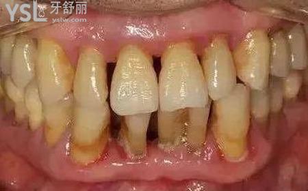 牙齦萎縮疼怎么辦？
