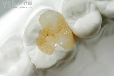 樹(shù)脂修復(fù)后牙根裸露是怎么回事？