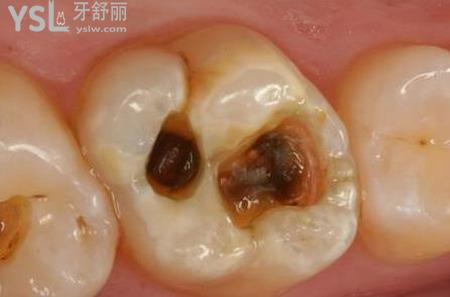 牙洞很深很黑是怎么回事？