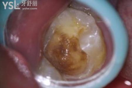 什么是光固化樹(shù)脂修復(fù)？