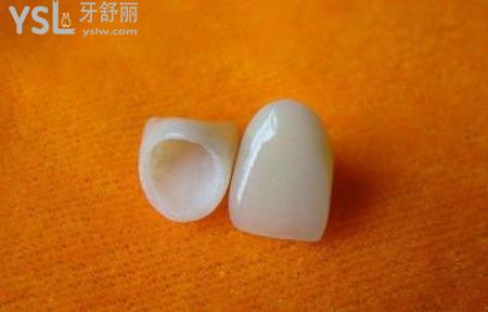 全瓷修復(fù)后注意什么？