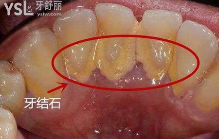牙結(jié)石為什么會(huì)那么臭？