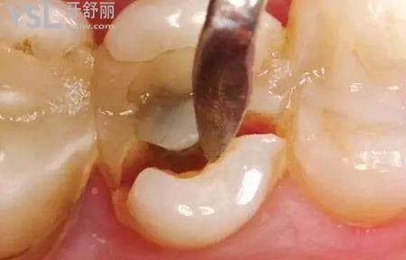 大牙掉了一小塊能長(zhǎng)么？