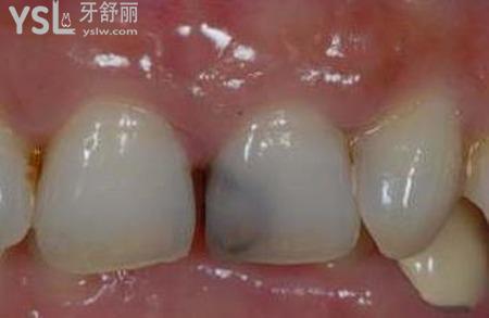 小孩齲齒怎么治療？
