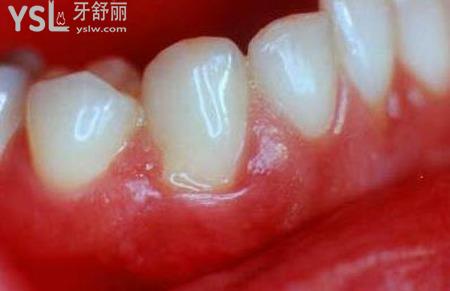 牙齦腫痛怎么回事？