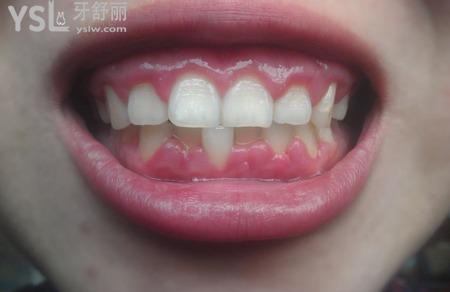 牙齦癢是什么原因？