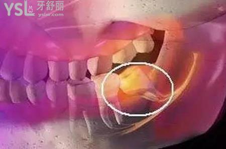 牙長(zhǎng)智齒特別疼怎么辦？
