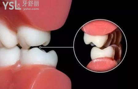 牙后根腫痛怎么回事？