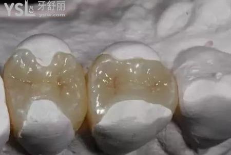 牙齒嵌體多少錢(qián)？