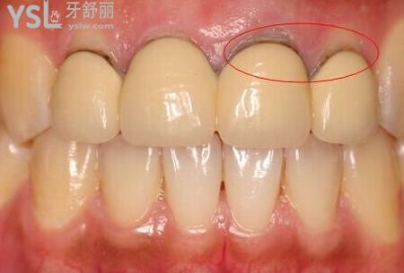 牙根發(fā)黑怎么治療？