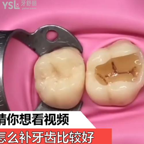 怎么補(bǔ)牙齒比較好？