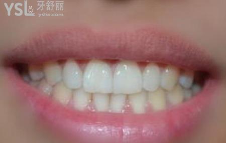 瓷貼面修復(fù)的注意事項有哪些？
