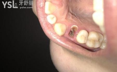 牙根爛掉了怎么辦？