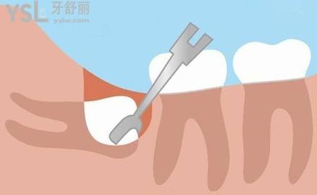 拔磨牙后一般要疼幾天？