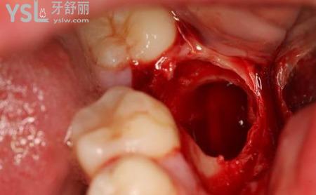 拔過智齒后有一個洞怎么辦？