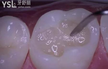 牙齒空了一半可以補(bǔ)嗎？