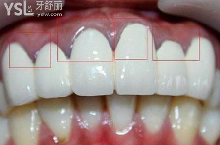 牙齒全掉完了能做烤瓷牙嗎？