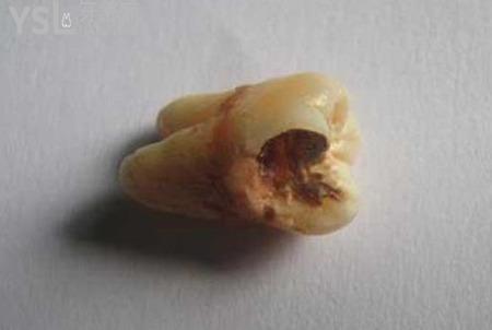 智齒拔牙多久能好？