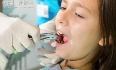 牙痛的時候可以拔牙嗎？