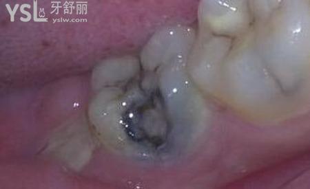 牙齒凹槽上面有黑色怎么去除？