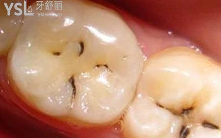 輕度較淺齲齒怎么治療？