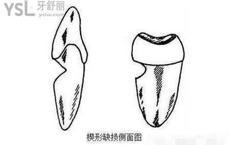 楔狀缺損補(bǔ)牙多少錢？