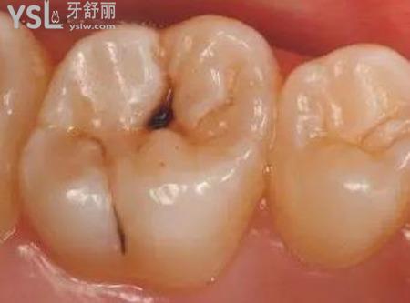 蛀牙會(huì)傳染相鄰的牙嗎？