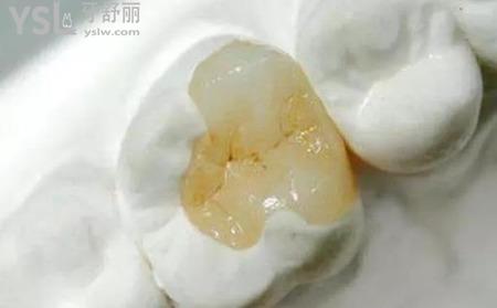 嵌體補(bǔ)牙多少錢？